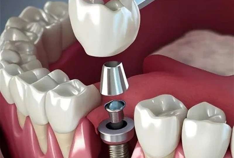 تبلیغ ایمپلنت فوری دروغ است/سلبریتی‌ها حق تبلیغ خدمات پزشکی را ندارند